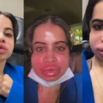 Urfi Javed Skin Problem