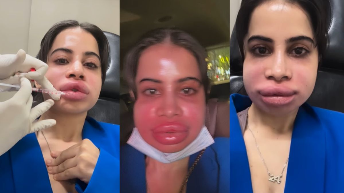Urfi Javed Skin Problem